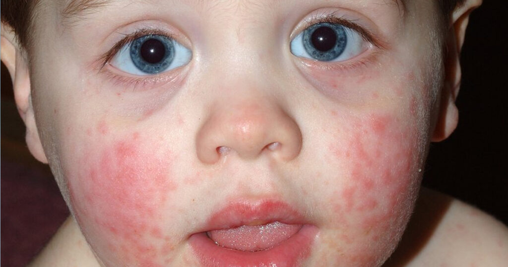 Eczema Products to Soothe Your Babys Skin